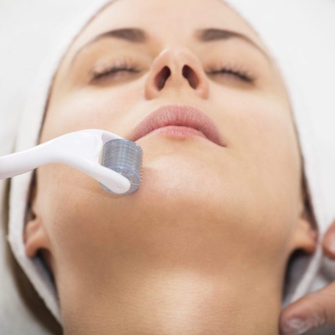 Face microneedling treatment with a meso roller.